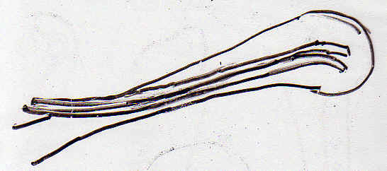 Embrochage intramdullaire