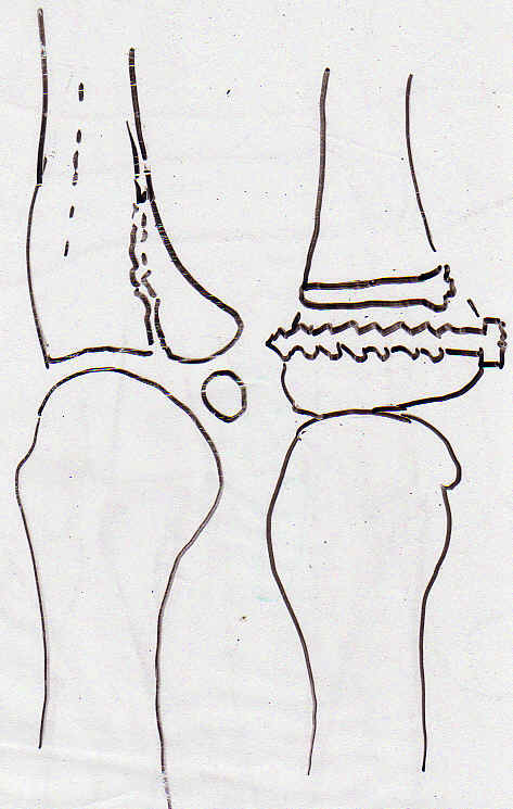 Fracture  articulaire d'une base.