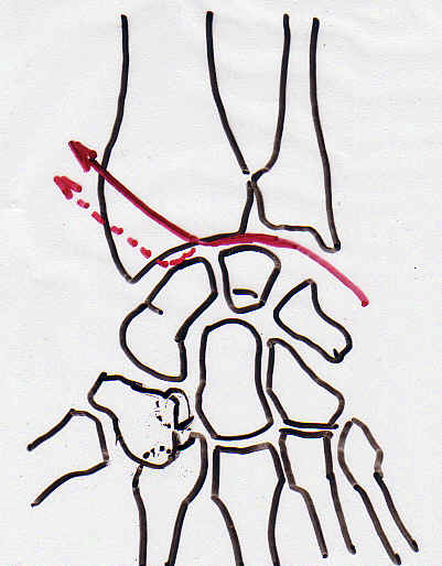 Luxation radio carpienne avec fracture transradiale.
