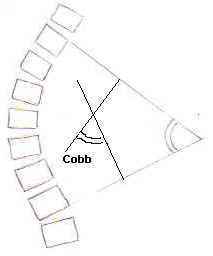 Mesure de l'angle de Cobb.