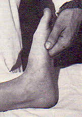 Brivet du tendon d'Achille.